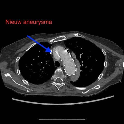 Nieuw aneurysma proximaal van de thoracale endoprothese.