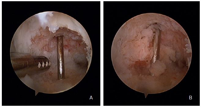 Peroperatieve artroscopiebeelden: A. Artroscopisch zicht met debridement pseudartrosehaard. B. Plaatsen van de eerste botenten.