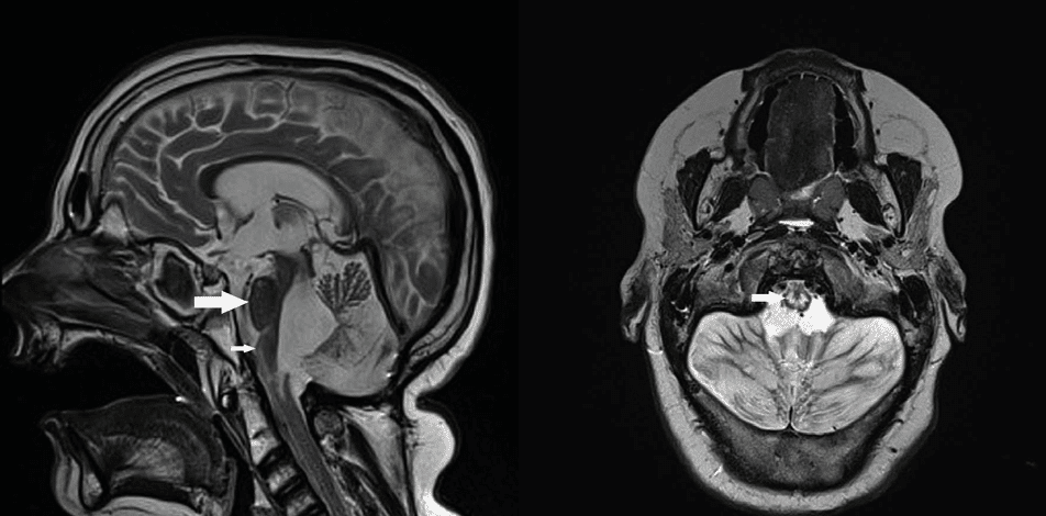 MRI toont schade in hersenen aan
