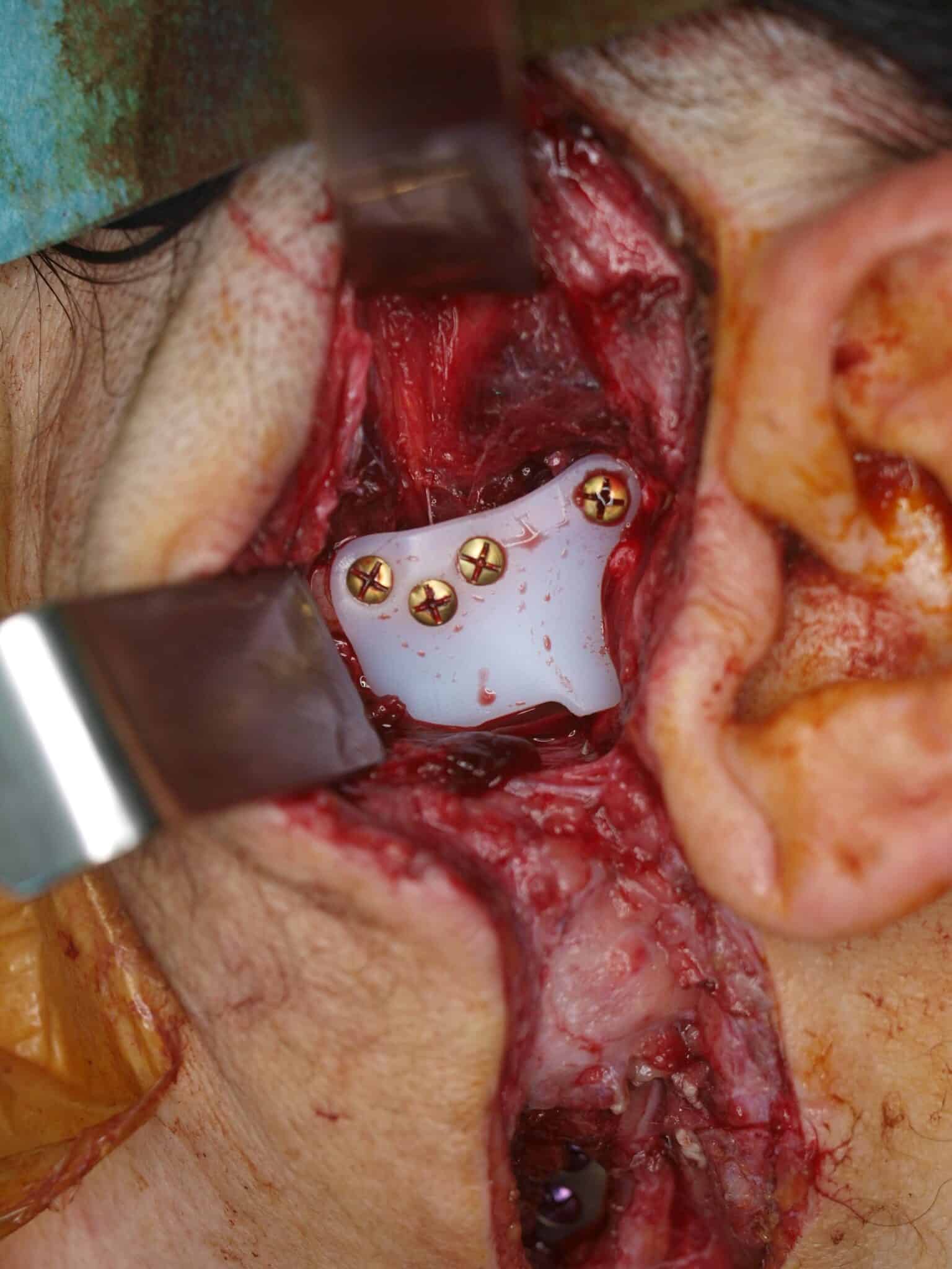 Figuur 6: Fossa-component ingebracht via een preauriculaire incisie