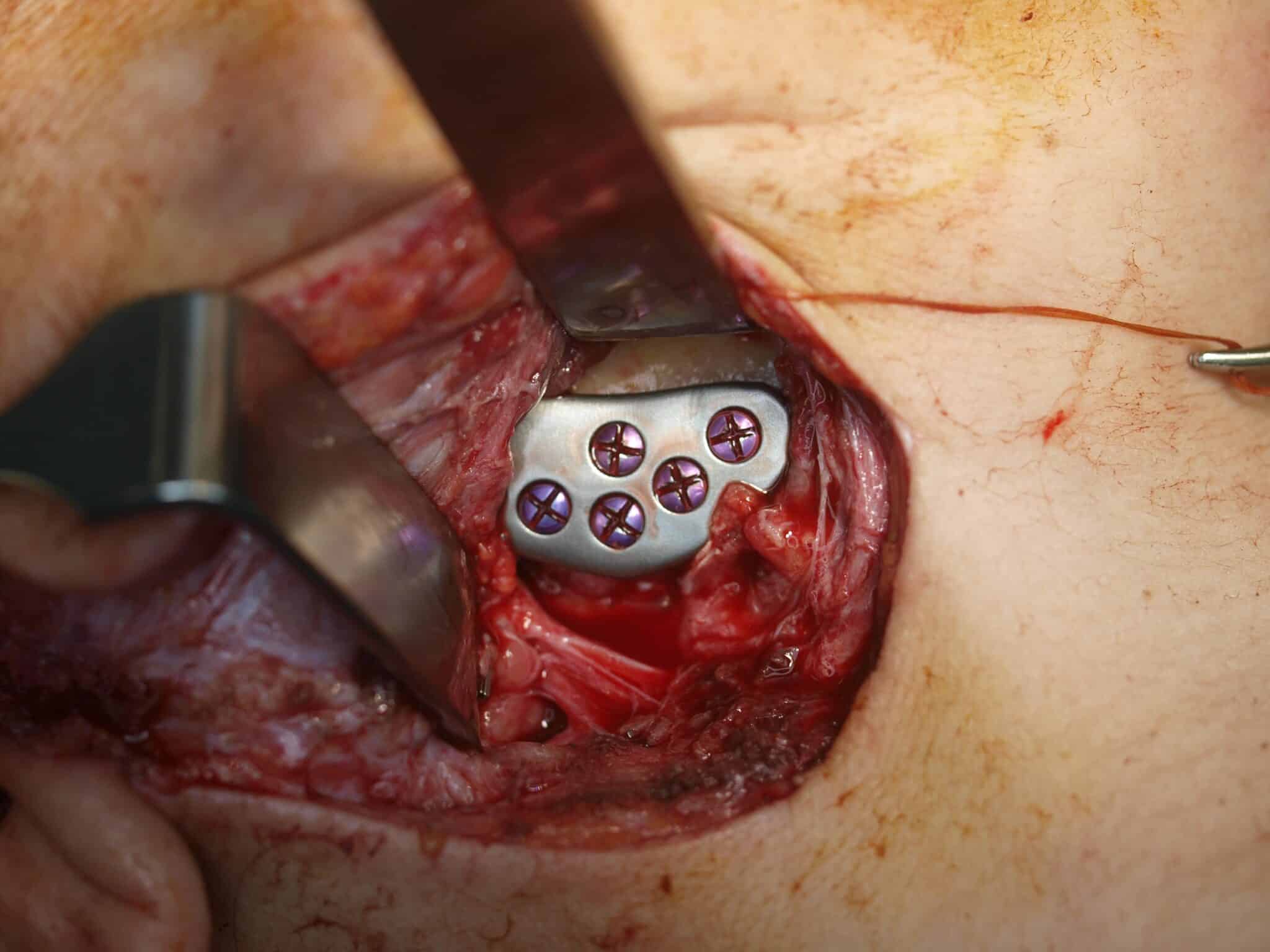 Figuur 7: Mandibulaire component, ingebracht via een retromandibulaire incisie