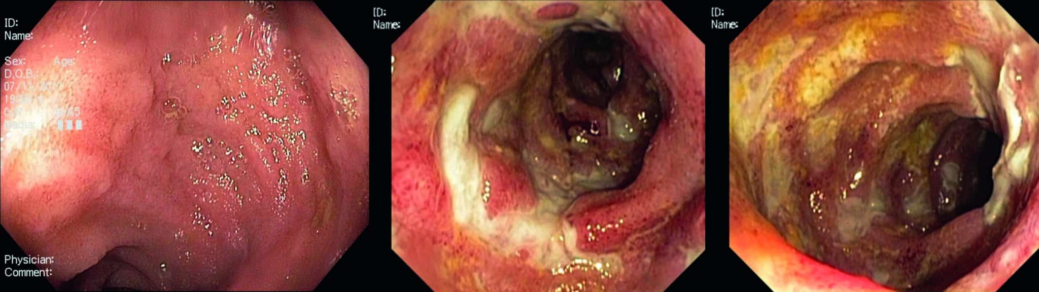Endoscopische afbeeldingen : A. Normaal terminaal ileum. B en C. Confluerende ulcera in het terminale ileum bij M Crohn