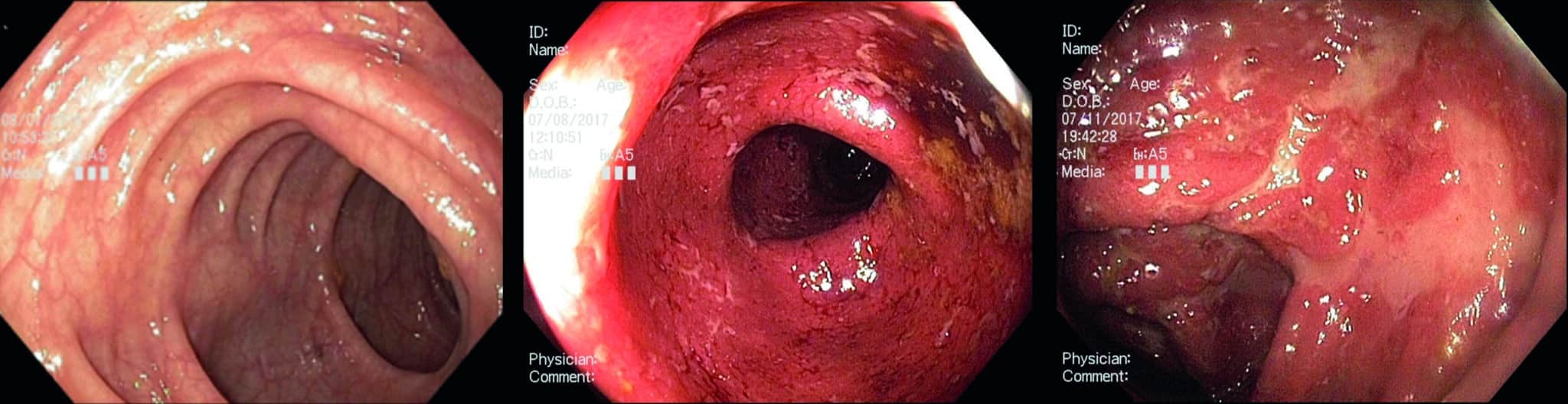 Endoscopische afbeeldingen: A. Normaal colon. B. Colitis ulcerosa met verdwijnen van normaal vaatpatroon, erytheem, friabiliteit en verpreide kleine ulcera. C. Ernstige colitis ulcerosa met grote confluerende ulcera in het colon.