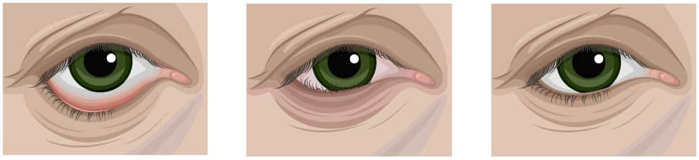ooglidchirurgie Ectropion