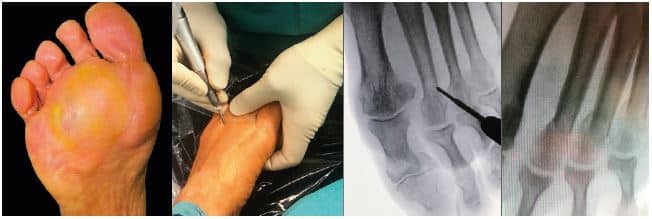 voet en enkel chirurgie